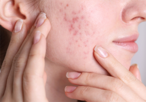 మొటిమల గురించి ఈ షాకింగ్ నిజాలు తెలుసా..